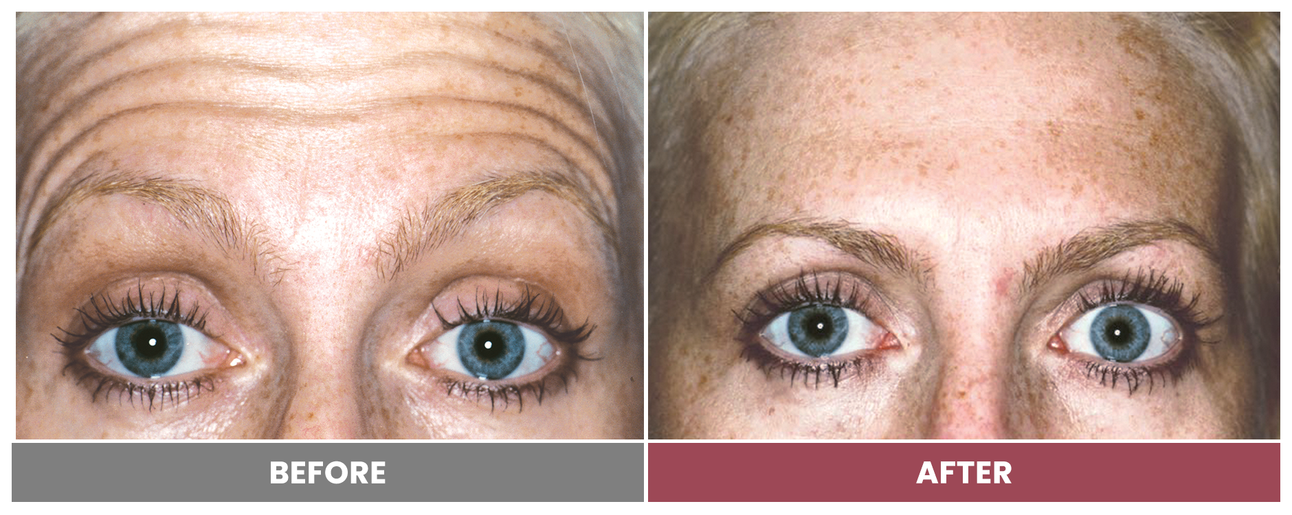 BOTOX FOR WRINKLES & BROW LIFT - Case 1